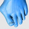 BunionEase Comfort Aligner